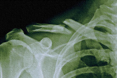 Possible-Bone-Fracture-My-Auto-Accident-450x300