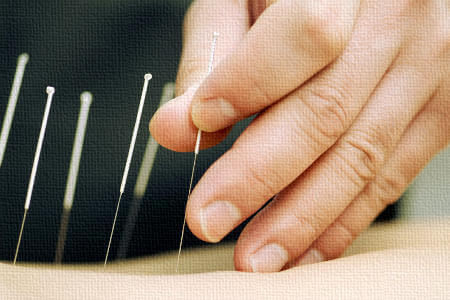 Services-Acupuncture-My-Auto-Accident-450x300